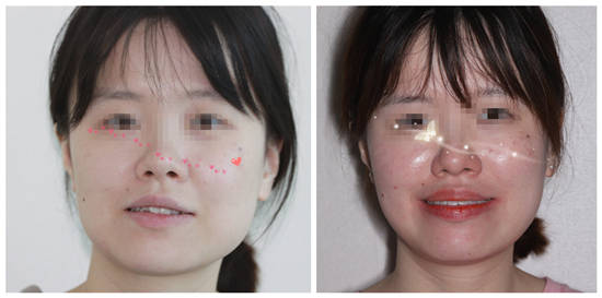 纯钛牙套价格,深度解析与科普