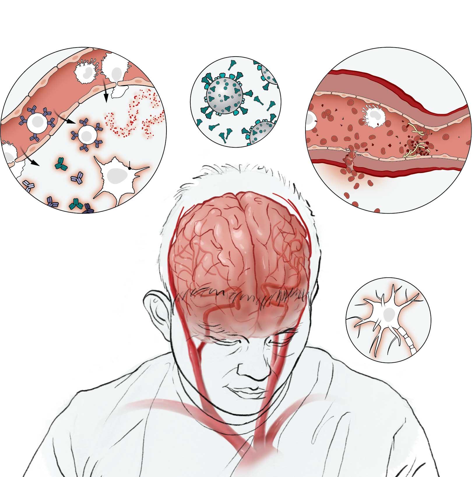 最新感染病人概述