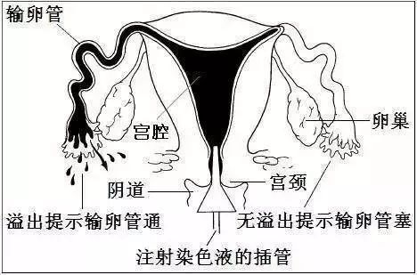 输卵管堵塞治疗