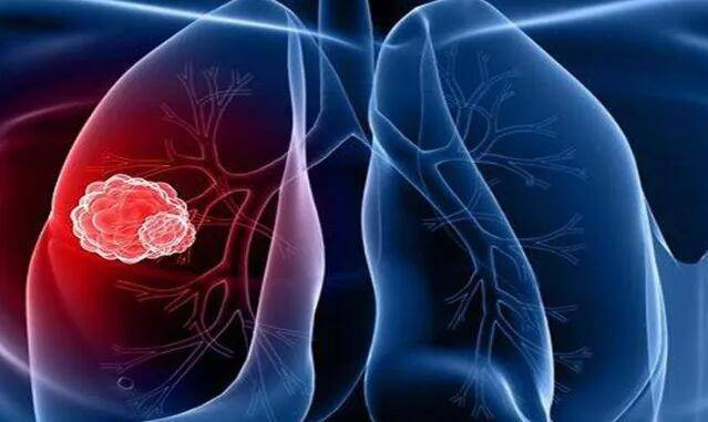肺鳞癌最新治疗方案